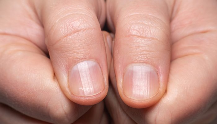 unhas-estriadas-e1752516773662.jpg